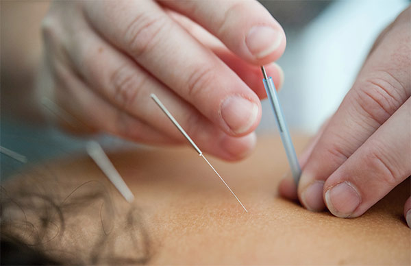 traitement d'acupuncture